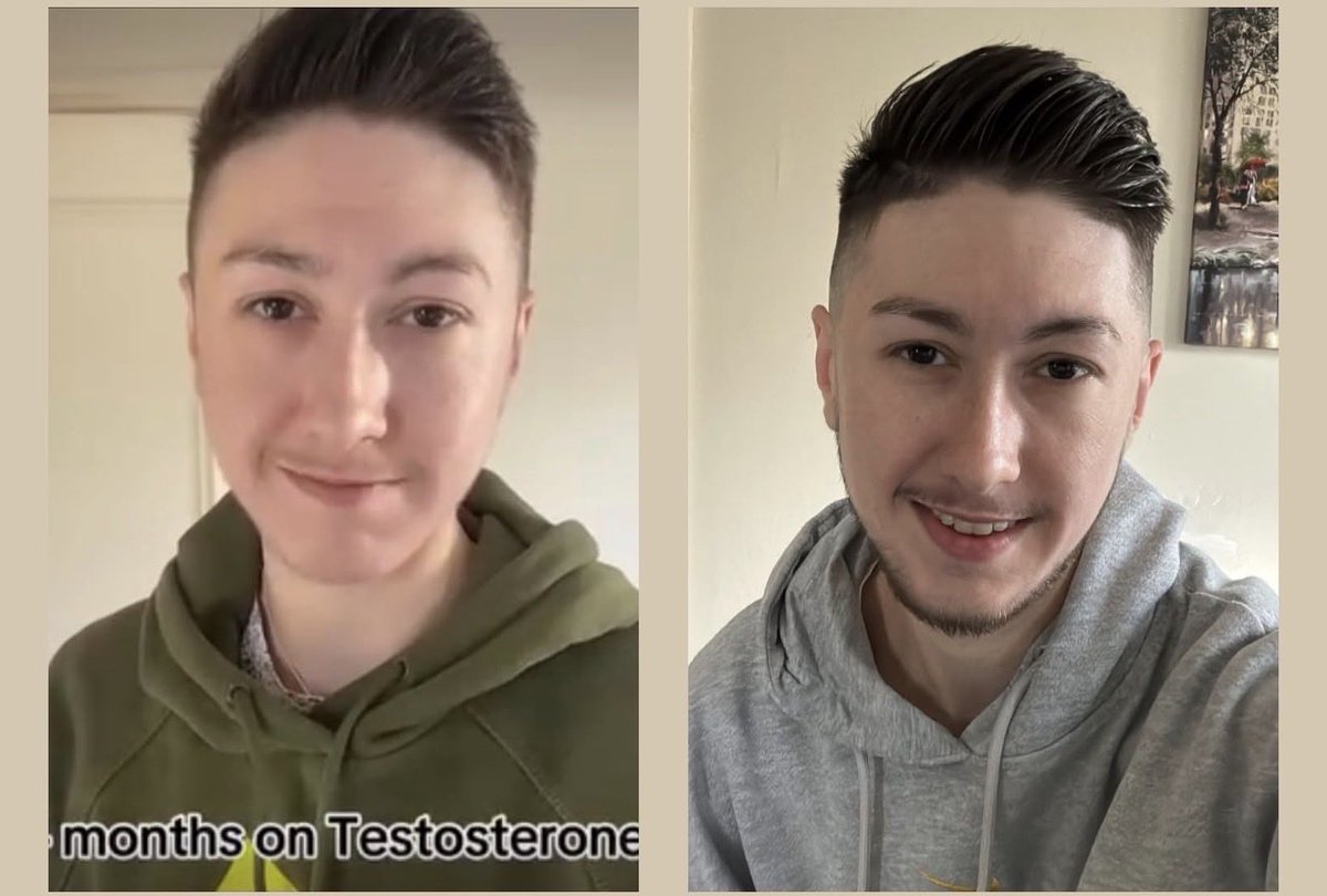 Today marks 2 years 4 months on testosterone 🎉😁❤️
