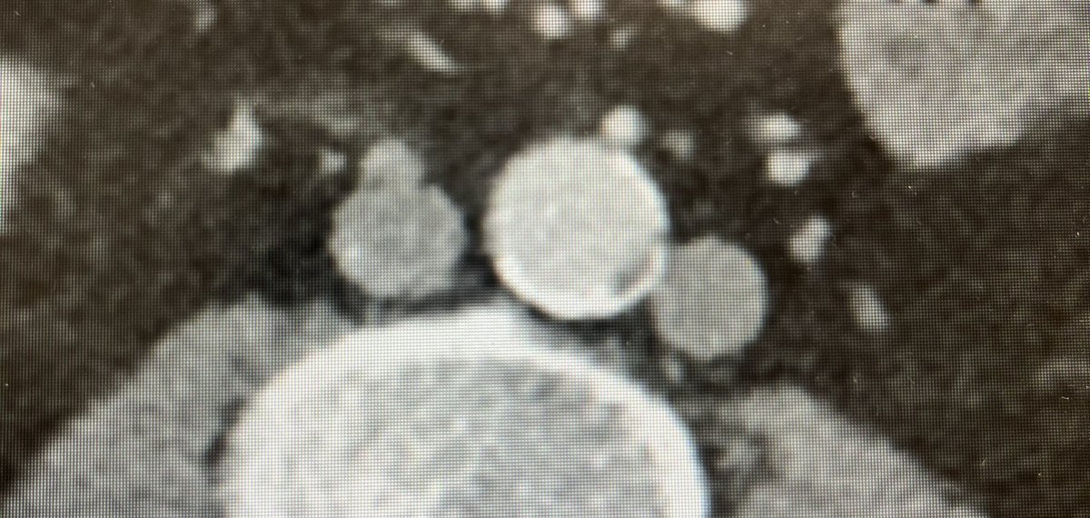 Duplicated IVC is a rare congenital anomaly where a second inferior vena cava (IVC) forms alongside the normal one, resulting in two parallel venous channels on either side of the aorta. It is usually asymptomatic and discovered incidentally on medical imaging