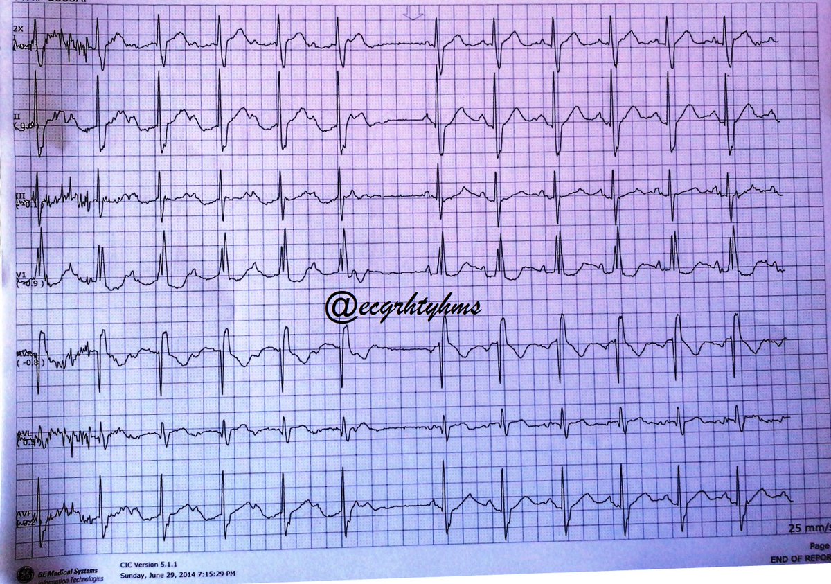 103125
Happy Halloween

A pt with h/o of HTN was admitted due to ischemic stroke.
What does the captured ECG suggest?

Poll next