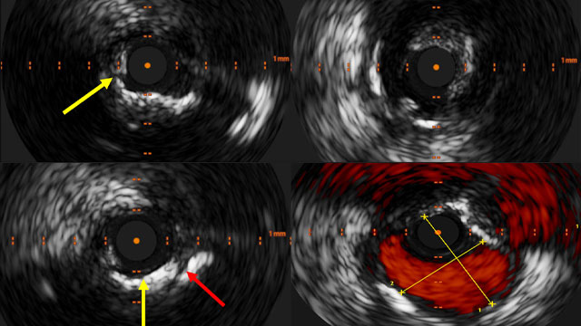 Calcium nodule in circumflex ostium: a complex problem. Do you remember this challenging case of an 83-year-old male with severe COPD, PAD, and unstable angina?

Part 2 is now online ➡️ pcronline.com/Cases-resource…

A calcified nodule at the circumflex ostium made revascularisation