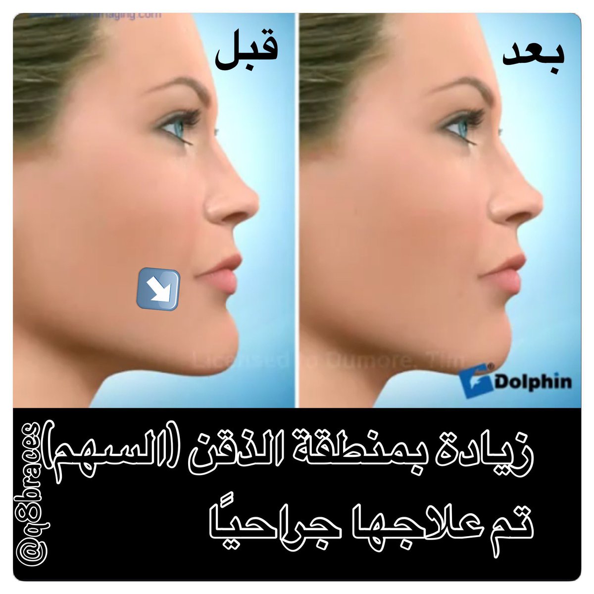 يعاني بعض  #البنات بزيادة بمنطقة الذقن (الصورة)، علاج تقويم #الأسنان لوحده لا يكون كافي للوصول للنتيجة المثالية. الحل الأمثل هو عمل تقويم جراحي. بالسابق كان هذا النوع من #العلاج يعتبر صعب ولكن مع تطور #الطب، أصبحت الأمور أسهل والنتائج أفضل ..

#الكويت
#Kuwait
#كويتيات
#Braces