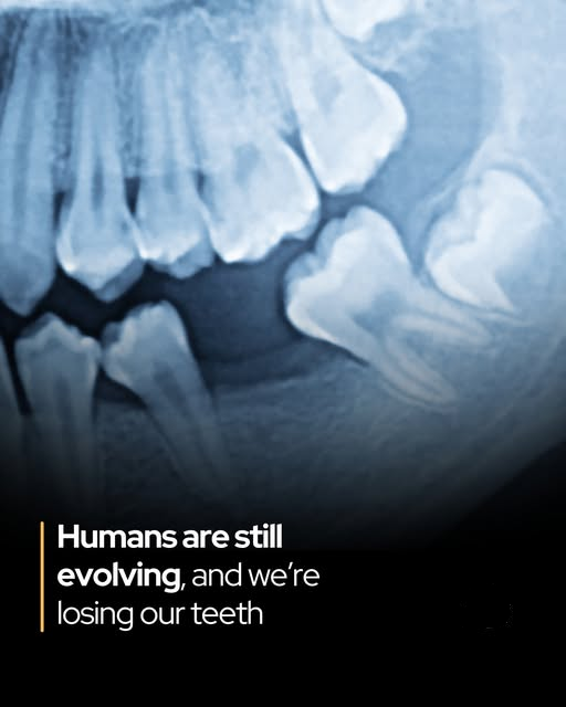 More people are being born without adult teeth – an evolutionary shift.

A major study in Scientific Reports reveals that more individuals today are born without certain permanent teeth—not from loss or damage, but because the teeth fail to develop entirely. This phenomenon,