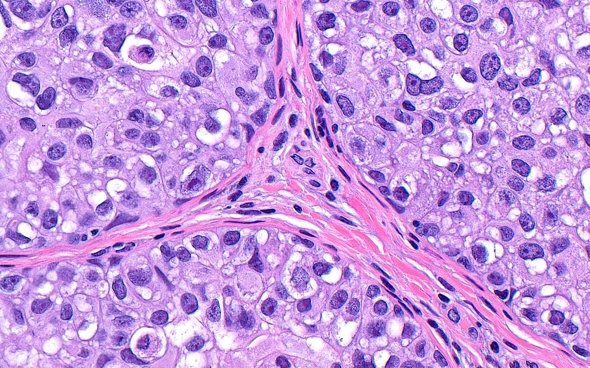 🔬📷 DCIS (Ductal Carcinoma in Situ) ~ #Pathology #BreastPath #Pathart