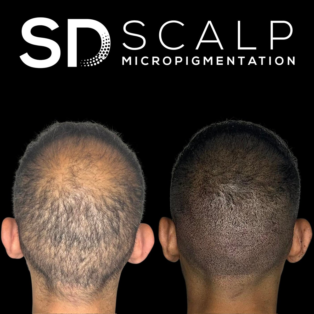ScalpDesigns's tweet image. Boston’s #1 Scalp Micropigmentation Clinic 💥 | Non-surgical hair loss solution for men &amp;amp; women | Book your consultation 👉 scalpdesigns.com | 📍Milton, MA  #scalpmicropigmentation #smp ##hairtattoo ##micropigmentacioncapilar