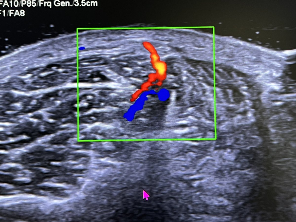 AtulTolia's tweet photo. HELP ?What ?Why ?MR needed
47 Male with 10 x 8 x 3 mm  subcutaneous small soft mobile and not tender palpable lump of left anterior shin of tibia region at upper calf area. Thanks
@mskteachingroom @radiologybmj https://t.co/62rwVTnqcE