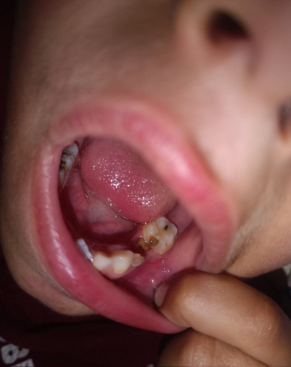 yousefQasem1998's tweet image. I WILL DIE😭 

My little Brother with the little heart is in crazy pain He is suffering from Tooth decay due to lack of FOOD, medicine AND calcium He is suffering from strife We NEED HELP to save his LIFE
 
3 replies — even dots — can break the
 algorithm 
chuffed.org/project/154635…