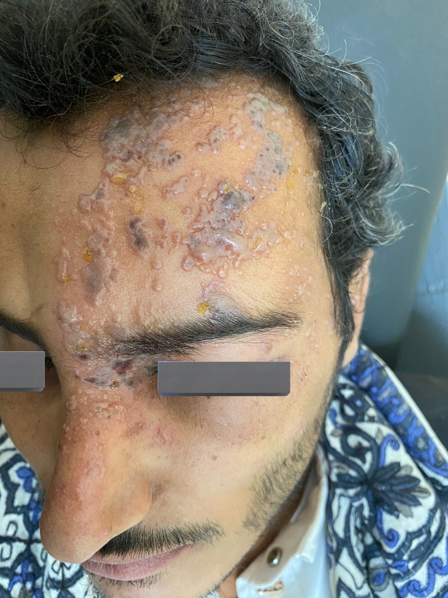 hemo_shk's tweet photo. #DX

What is the description or diagnosis ?
Treatment?

#MEDHM #MedX @IhabFathiSulima https://t.co/sN8wjaAao0