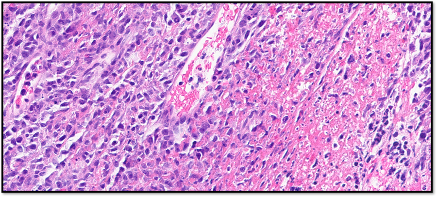 ~70M bilateral adrenal mass, biopsy (right)