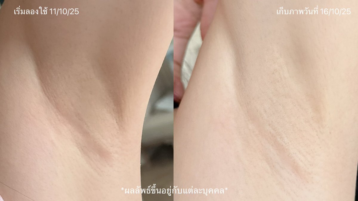 joyjeeloveberry's tweet image. เมื่อก่อนเลือกเสื้อออกกำลังกาย = เสื้อมีแขนเท่านั้น อายผิวใต้วงแขนมาก เพราะทั้งไม่เรียบ ไม่ผ่อง แถมคล้ำอีก ยิ่งเป็นคนขาวมากๆ ยกแขนทีคือโคตรอาย มาเจอ NIVEA EXTRA BRIGHT เปิดใจลองทาแค่เกือบอาทิตย์ รู้สึกรอยพับดูจางขึ้น ผิวดูใสขึ้นด้วย ที่สำคัญคือหอมมาก!…