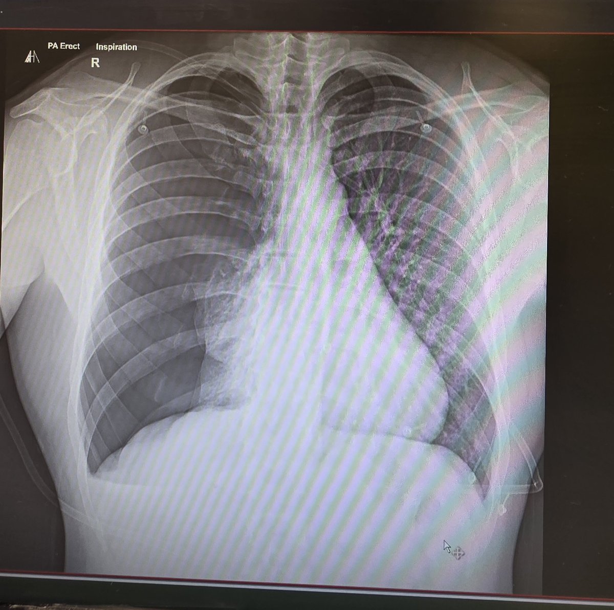 I was in the gym 14 days ago like any other Monday morning. I was doing an explosive single leg glute bridge as part of my plyometrics. Some how that caused a full collapse of my right lung. 13 nights in hospital and VATS surgery later, I'm finally discharged. Wtf 😂