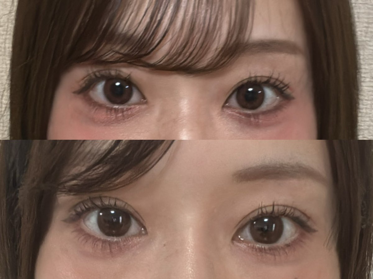 nipponnosu's tweet photo. ウィバース美容整形外科（@uversejp）
鼻整形自然癒着をして１ヶ月経ちました🌸
院内もとても綺麗でスタッフさんも日本語通訳さんもいてとてもスムーズでした！

元々低い鼻と片目だけ奥2重でしたがそれが解消されて凄く満足しています🥲🩷 https://t.co/Clye8eM1aw