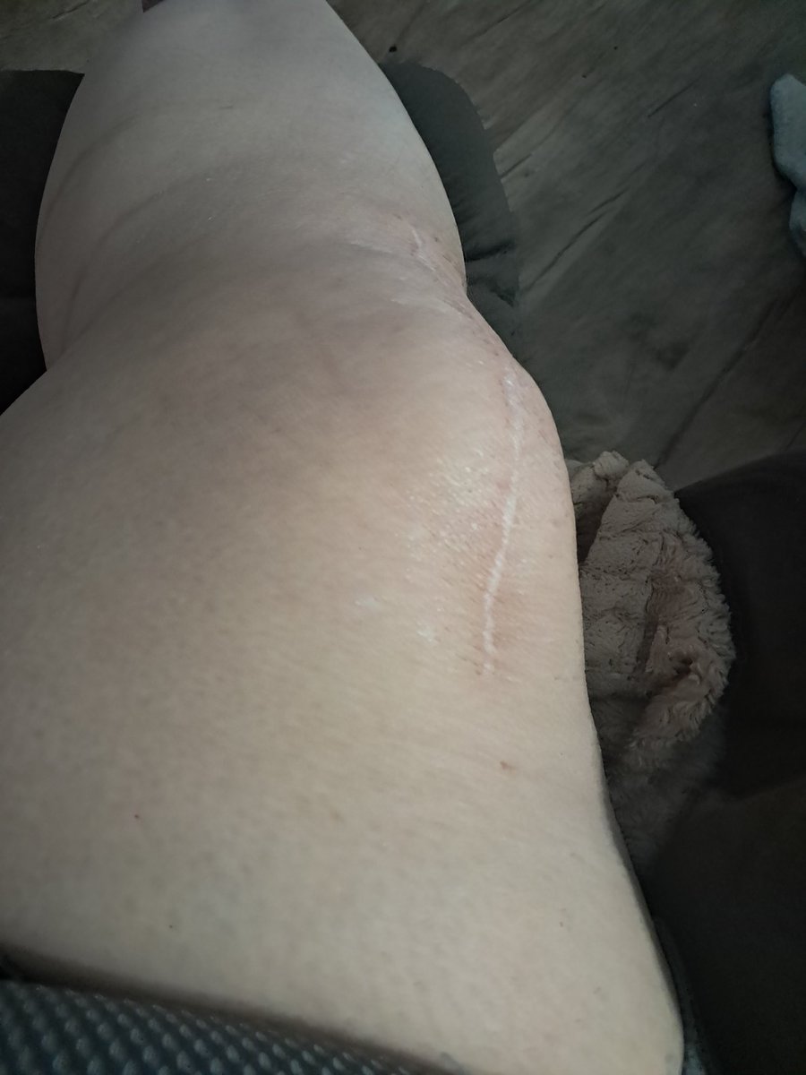 Left picture is 8th month post knee revision surgery. Right picture is 1 year post knee replacement. 8 months and does anyone else see the problem with the left knee. Im still on a walker and cane!