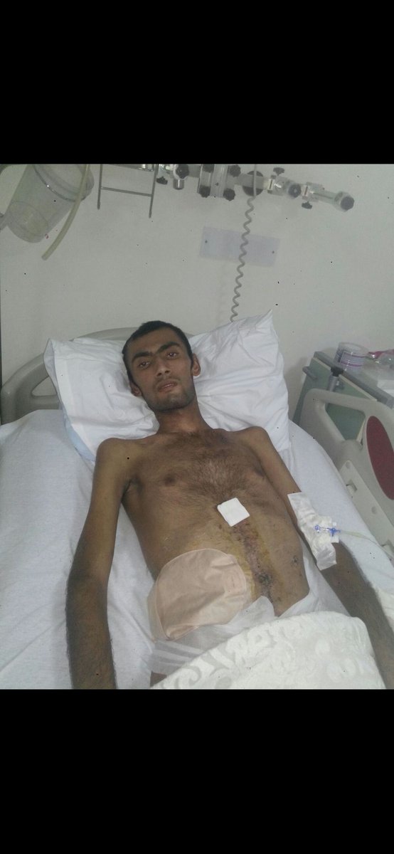 Nöbet tuttuğu tepeye füzeyle saldırdılar. Bir bacağını kaybetti, bağırsakları toprağa boşaldı. Bağırsak nakli oldu, protez bacak takıldı, ameliyatlarla hayata tutunmaya çalıştı.

Dün 54. ameliyatını geçiren Gazi Adnan Yavuz'a her mesaj, şifa ve moral olsun.

Minnettarız... 🇹🇷