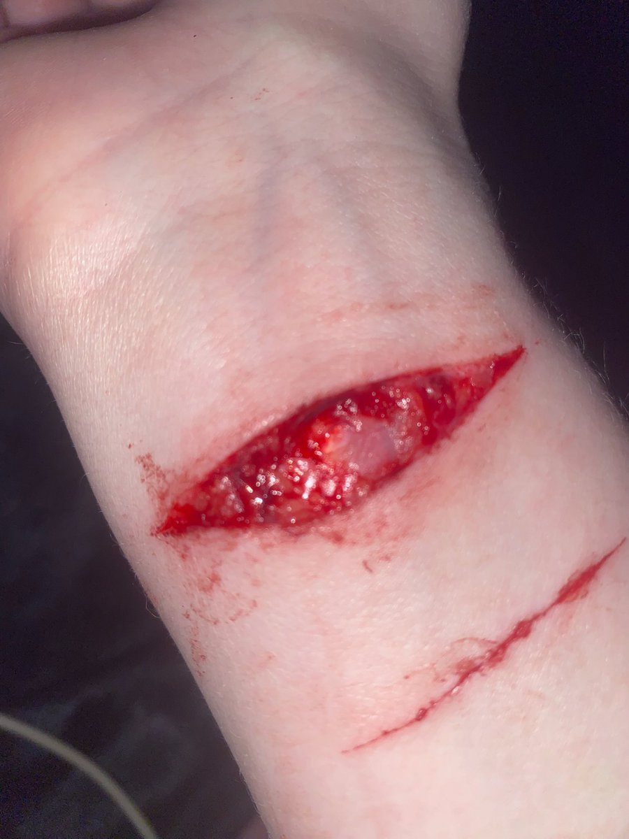 vertigodrugs's tweet photo. Fucked up pretty bad last night, had to get stitches today #shtwt https://t.co/qGALKq4Wio
