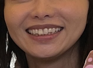 napi_biaka's tweet photo. 汚い下半身見せてごめんー！この口元のシワシワってどうしたら改善できるんだろう？ミッドフェイスリフト、フェイスライン脂肪溶解注射は済みです…165㌢55㌔です…ダイエット？？ https://t.co/y25GfaWDDp