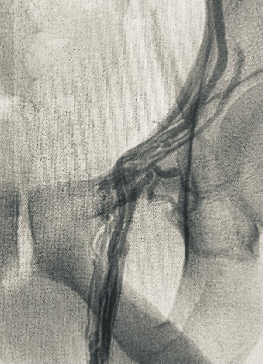 سألني المريض (أثناء عمل القسطرة) هل يتضح عندك لماذا عادت لي دوالي الخصية بعد العملية المجهرية؟ طبعاً واضح لنا وجود عدد مهول من الاوردة التي لم يتم ربطها جراحياً… ترك بعض الأوردة هو احد اهم أسباب فشل العملية المجهرية… تم علاج الاوردة كلها بنجاح بالقسطرة.