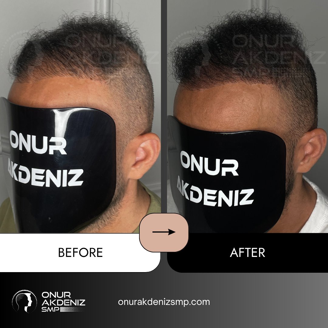 onurakdenizsmp's tweet image. ✨ Transformations that speak louder than words!
Each session is not just about technique, it’s about restoring confidence and redefining style.
Proud to witness another client leave with a smile! 💎

#scalpmicropigmentation #micropigmentation #hairmicropigmentation #smp…