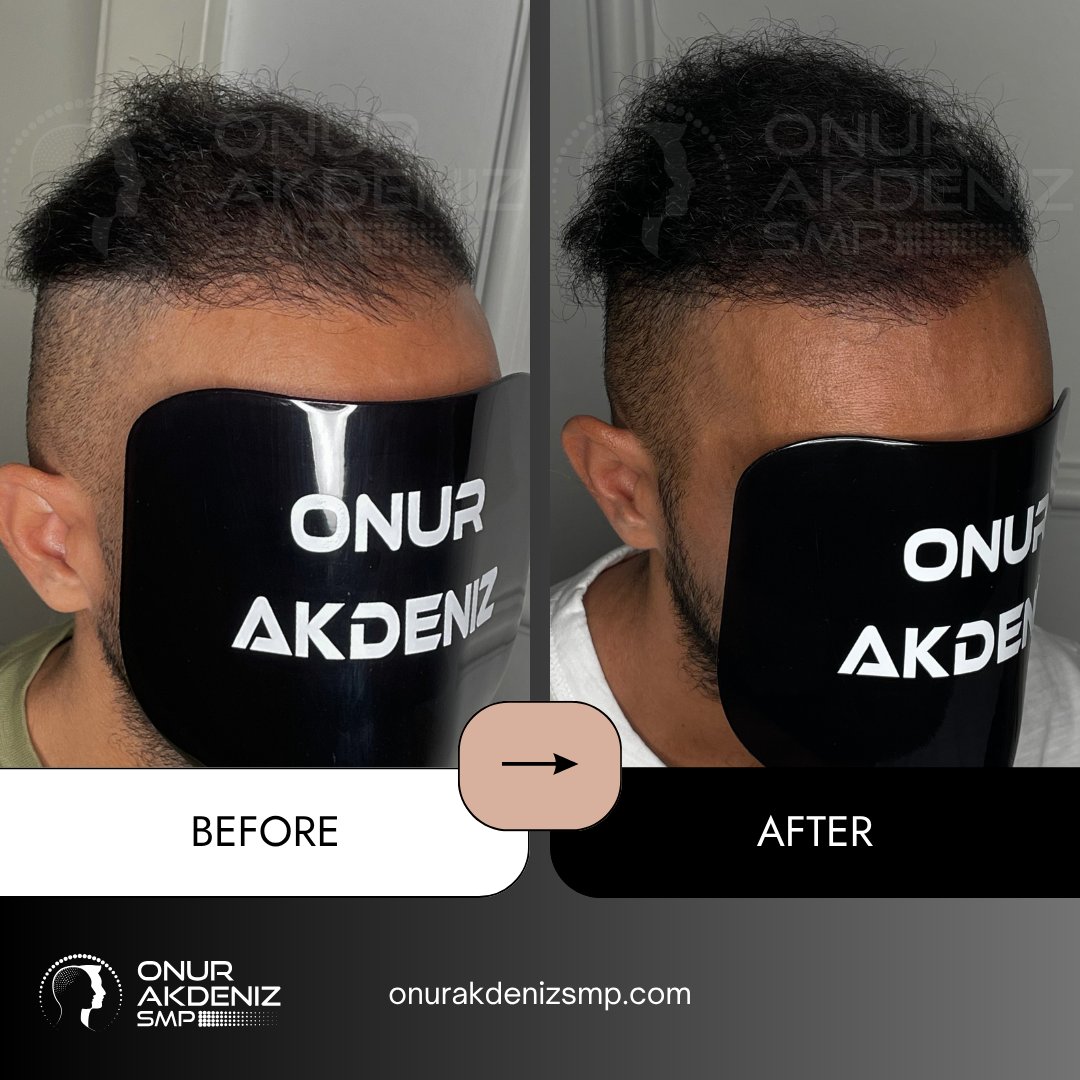 onurakdenizsmp's tweet image. ✨ Transformations that speak louder than words!
Each session is not just about technique, it’s about restoring confidence and redefining style.
Proud to witness another client leave with a smile! 💎

#scalpmicropigmentation #micropigmentation #hairmicropigmentation #smp…