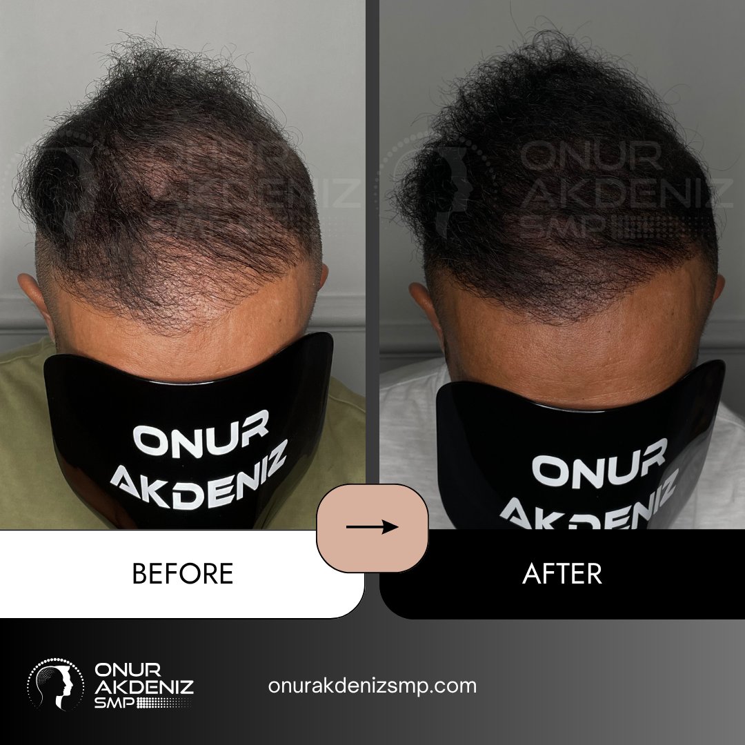 onurakdenizsmp's tweet image. ✨ Transformations that speak louder than words!
Each session is not just about technique, it’s about restoring confidence and redefining style.
Proud to witness another client leave with a smile! 💎

#scalpmicropigmentation #micropigmentation #hairmicropigmentation #smp…