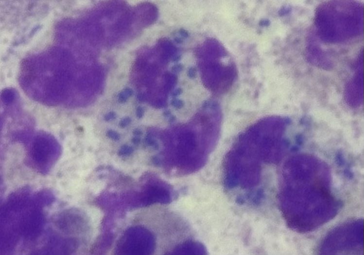 #urethral dishcharge male
#giemsa stain

Numerous (PMNs), Intracellular and extracellular diplococci 
🧬 Diagnosis is highly suggestive of
👉 Neisseria gonorrhoeae infection

🧍‍♂️ Confirmatory test
•Gram stain
•Nucleic acid amplification test (NAAT)