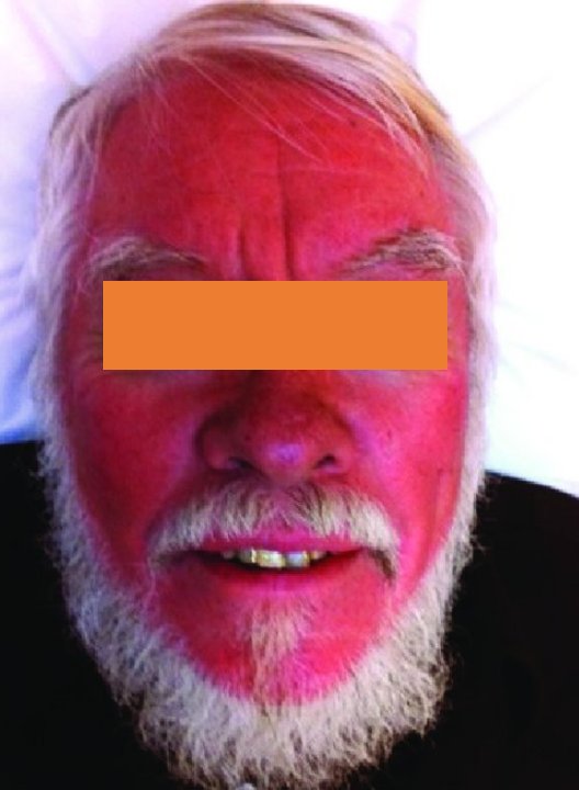 IhabFathiSulima's tweet image. History of severe Diarrhea and wheezing.
What is the diagnosis?