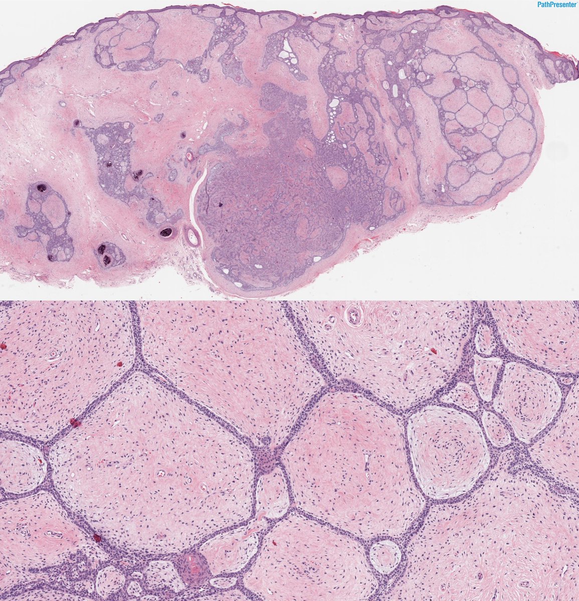 60-year-old woman with a pink, flesh-colored papule on the lower back.
🔬 Biopsy shows prominent epithelial and stromal components.
Diagnosis?
A. Basal Cell Carcinoma
B. Phyllodes tumor 
C. Tumor of the Follicular Infundibulum
D. Trichoblastoma
#PathTwitter #Dermpath