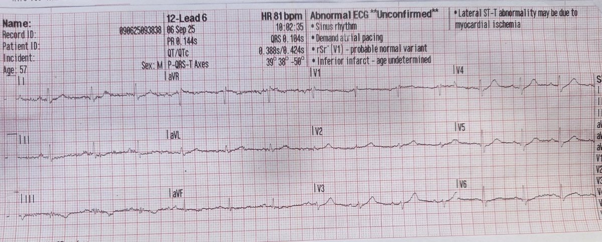 <a href="/smithECGBlog/">Stephen W. Smith</a> Steve, because of your work I have been able to routinely catch these frequently missed OMI patterns. I just had this fantastic case of a 54 yoa male with 2/10 cx px, not sick in appearance and thinks his anxiety is the cause of today's event. I know the outcome but I'm sure you