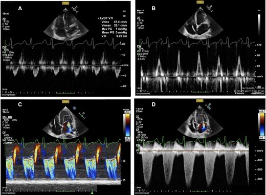 Cardiac ultrasound in cardiovascular emergency and critical care: a clinical consensus statement of the European Association of Cardiovascular Imaging, the Anaesthesia and Intensive Care doi.org/10.1093/ehjci/… #Echofirst #echofirst #Cardiology #cardiophile