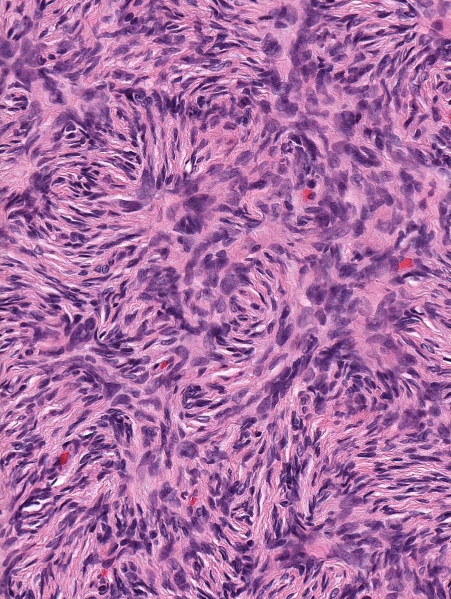 20 yo "cyst" on trunk. Diagnosis?
Answer ✅ ⏯️ youtube.com/watch?v=3u7uL9… 
Digital slide🔬kikoxp.com/posts/17369
See also: kikoxp.com/posts/16903 &amp; kikoxp.com/posts/10744 
#BSTpath #pathology #pathTwitter #dermpath #dermatology #dermatologia #dermtwitter