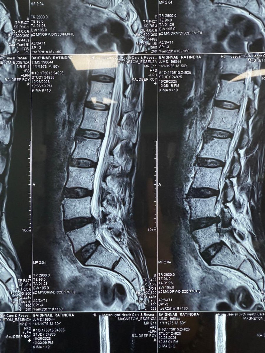 JJIMS_Silchar's tweet image. Today morning @drrajdeeproy  a spine surgeon by training and qualification successfully completes a decompression of L4-5 ( Laminectomy and Root Clearance ) in a 50 yr old male.

#SpineSurgery
#DiscProlapse
#FootDrop