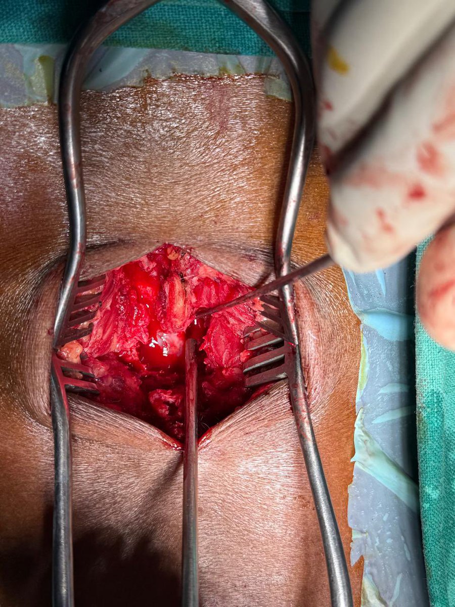 JJIMS_Silchar's tweet image. Today morning @drrajdeeproy  a spine surgeon by training and qualification successfully completes a decompression of L4-5 ( Laminectomy and Root Clearance ) in a 50 yr old male.

#SpineSurgery
#DiscProlapse
#FootDrop