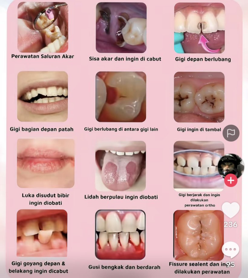 herastroo's tweet photo. Halo temen temen dom daerah denpasar dan sekitarnya, yang merasa dirinya/kenalan/saudara punya keluhan seperti di gambar ini boleh banget dm aku yaa 
terutama yg punya keluhan gigi hilang satu dan ingin dibuatkan gigi palsu boleh bgt dm aku🙌🥰
#koasgigi #denpasar #bali #zonauang https://t.co/KtF1rGckd7