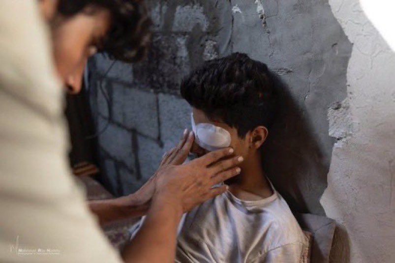 Abu_Salah9's tweet image. للتذكير

اقتلع الاحتلال عيناه عبر القنص.