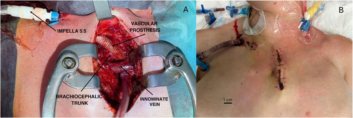 RevEspCardiol's tweet image. Impella implantation through the brachiocephalic artery: an alternative for left support in patients with small axillary access #REC #AheadOfPrint  revespcardiol.org/en-impella-imp…