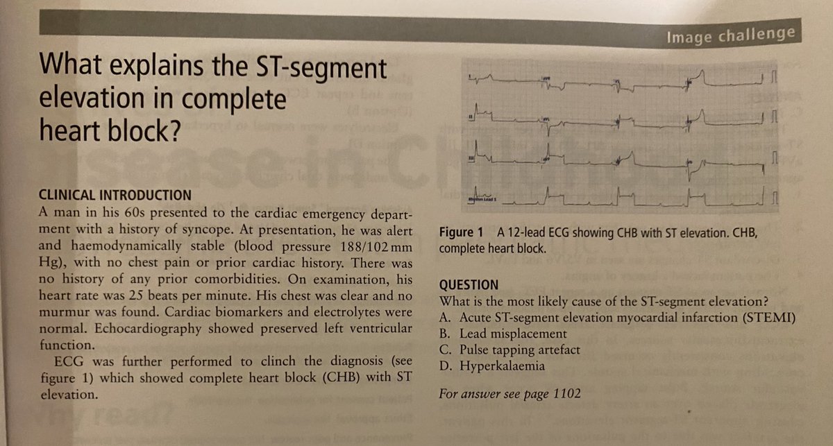DrDavidWarriner's tweet image. Amazing. Just written an ECG textbook (out very soon) and yet I’d NEVER come across this before. Still learning! 

Nice work @Heart_BMJ @sumitku3007 

#CardioEd #CardioX #cardiology #EPeeps
