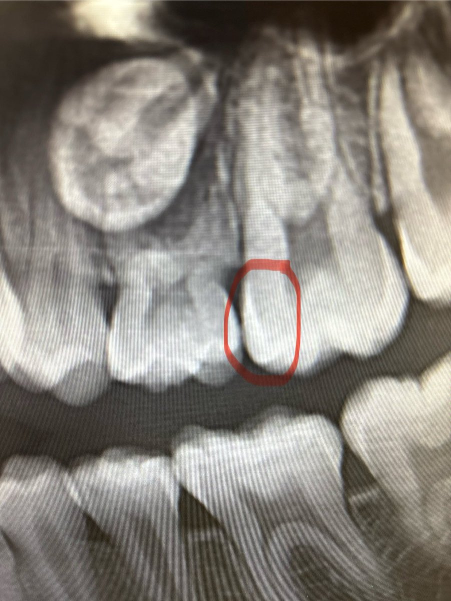 If people want to see the early stages of a cavity then this is it. 
The enamel is demineralizing below where the contact was with the primary molar that fell out. The mom texted me this and then I checked the last X-rays to make sure it’s on the surface only.