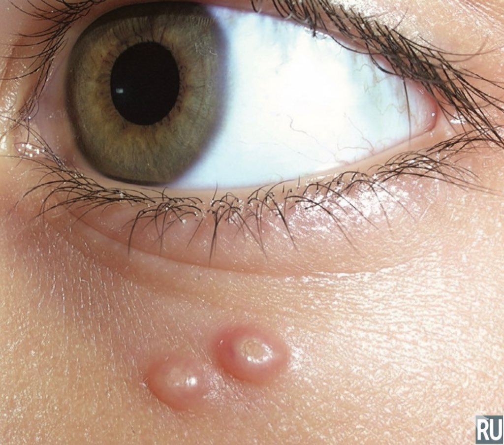 docxusofficial's tweet image. This lesion LOVES kids and immunocompromised adults

What is it?