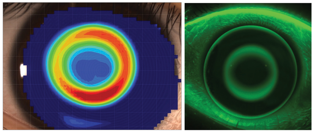 revoptom's tweet image. East Meets West: Myopia Management in the US and China

Take stock of each country’s approach to disease control and patient care and see what can be easily implemented in your practice: reviewofoptometry.com/article/east-m…
#myopia #myopiacontrol #myopiamanagement #optometry #eyecare #vision