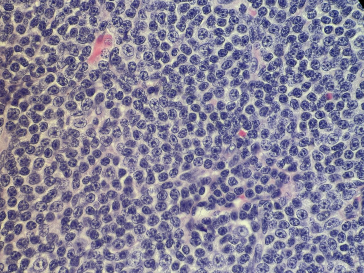 #Hemepath #Surgpath #Pathology Multiple neck lymph nodes. It is obviously a Lymphoma. I requested immunostains to classify. Your preliminary diagnosis ?