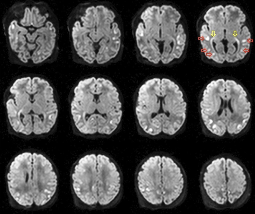 Journal of Neuroimaging tweet media