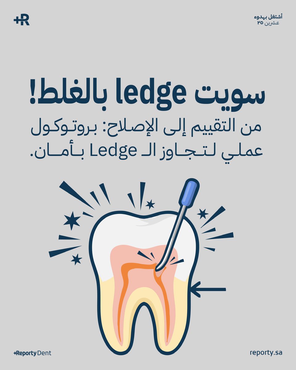 أيش يعني "ledge" ؟ 🔎📗
 
هو انحراف بسيط في جدار القناة، يصير لما الأداة تخلق “مسار كاذب” بدل المسار الأصلي 
يعني القناة تغيرت، والملف ما يقدر يوصل الـ apex بعد الآن

 الخبر الحلو ؟ أغلب الـ ledges قابلة للتصحيح لو تصرفت صح خلينا نشوف مع بعض كيف تتصرف صح  
 
ليش صار الـ Ledge ؟