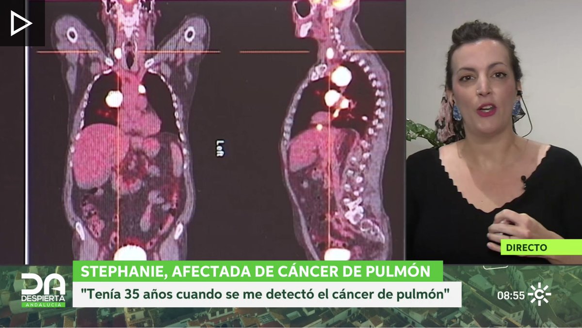 🔵🫁 #DíaInternacionalCáncerDePulmón | <a href="/StephanieDaRo/">Stephanie Da Rocha</a>, vocal de <a href="/AEACaP/">AEACaP</a>, ha contado en <a href="/DespiertaCSur/">Despierta Andalucía</a> su experiencia y cómo convive con una enfermedad que no sólo padecen las personas fumadoras o exfumadoras

ℹ️ canalsur.es/television/ste…