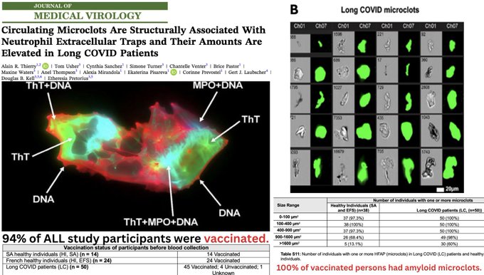 Obrázek A ukazuje fluorescenční mikroskopii extracelulárních pastí neutrofilů s označenou DNA MPO a elastázou ve vzorcích krve pacientů s long covidem. Obrázek B zobrazuje tabulku porovnávající počty amyloidních mikrosraženin u zdravých, neočkovaných a dlouhodobých skupin s dlouhým COVIDem, přičemž 100 procent očkovaných osob má amyloidní mikrosraženiny. Další obrázek zobrazuje čtyři panely kalami sraženin včetně hrubé anatomie ve sklenicích SEM mikrostruktury krystalovitých řezů, které ukazují vláknité struktury při různých zvětšeních. Další grafy zobrazují data z průzkumů od balzamovačů o procentu mrtvol s bílými vláknitými strukturami v žilách a tepnách v průběhu let, nárůstu úmrtí kojenců a pozorování velkých sraženin v roce 2024 ve srovnání s předchozími lety.