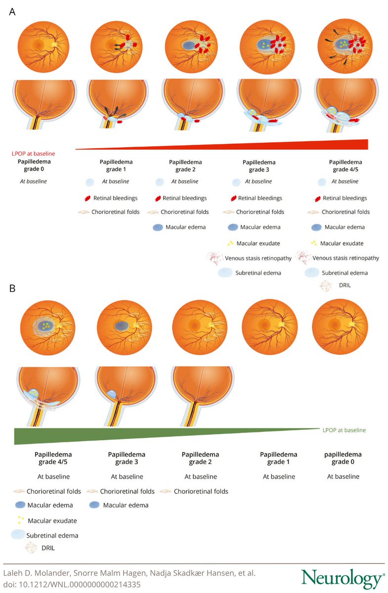 GreenJournal's tweet photo. Patterns of Retinal Damage and Visual Long-Term Consequences in Patients With Idiopathic Intracranial Hypertension: https://t.co/EKXKMnbuEa https://t.co/1tywUapbNg