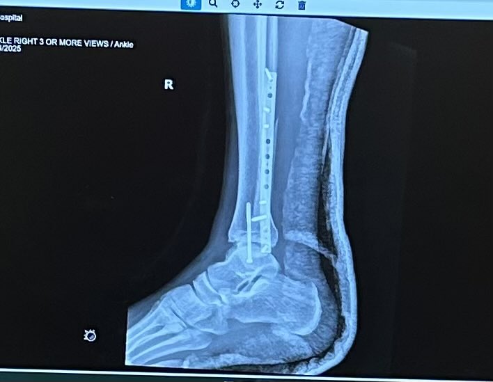 makethemflash's tweet photo. @camskattebo5 you might never see this but I had a trimalleolar ankle 2 weeks before your injury. First time ever having surgery and it mentally shook me up. Wanted to reach out and say the way you’re handling the injury in a positive light has encouraged me to do the same Cheers https://t.co/aIXAVtjZlq