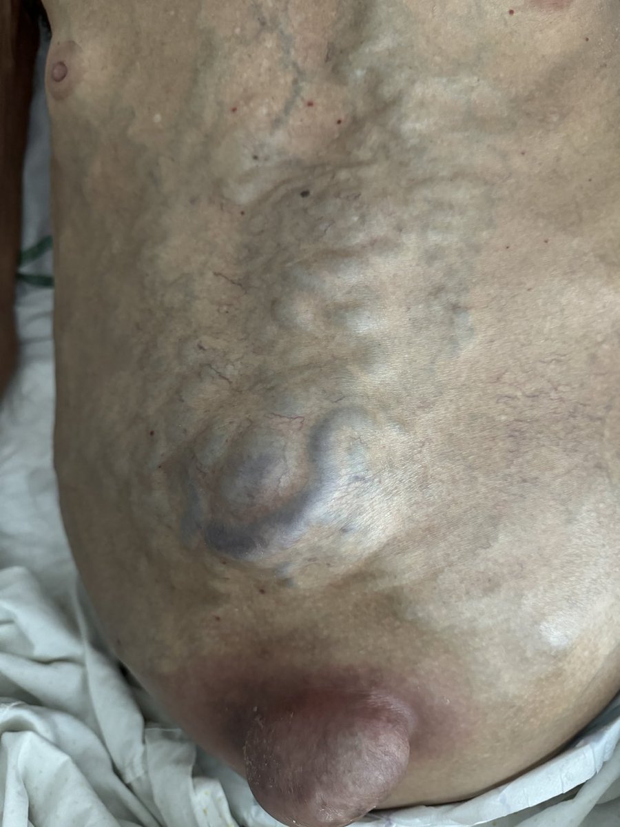 Caput medusae. Con permiso del paciente ⁦<a href="/drmiguelmarcos/">Miguel Marcos</a>⁩ ⁦<a href="/ResidentesSEMI/">Residentes y Jóvenes Internistas de la SEMI</a>⁩ ⁦<a href="/SonoSamMD/">Samuel García Rubio</a>⁩ ⁦<a href="/JMMR83/">Joaquín Martínez</a>⁩ ⁦<a href="/curromir/">Curro Miralles</a>⁩ ⁦<a href="/internavalle/">Residents Medicina Interna Hospital Vall d’Hebron</a>⁩ ⁦<a href="/interna_12/">Medicina Interna Hospital 12 de Octubre</a>⁩ ⁦<a href="/yaletung/">Yale Tung-Chen</a>⁩