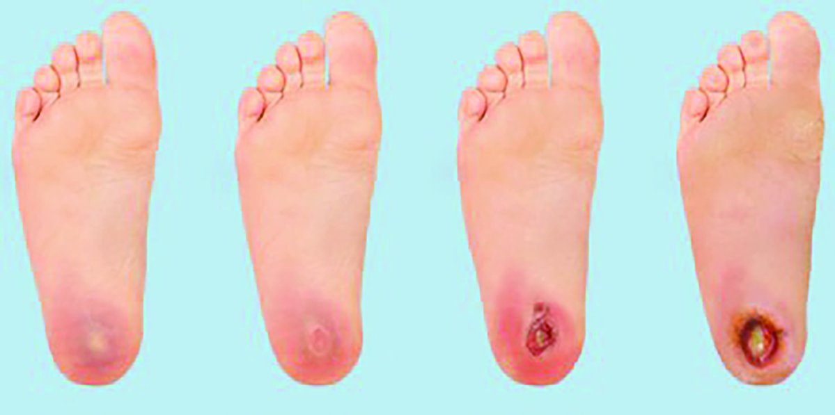 Alwatan_Live's tweet image. عبدالله محمد: التهاب العظم من أخطر مضاعفات القدم السكري وقد يؤدي إلى البتر

alwatannews.net/article/4065185