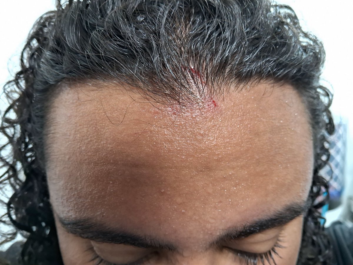 Fui abrir a loja hoje não vi a porta bati a cabeça no ferro e  cortei a testa ai olha CLT não tem um dia de paz