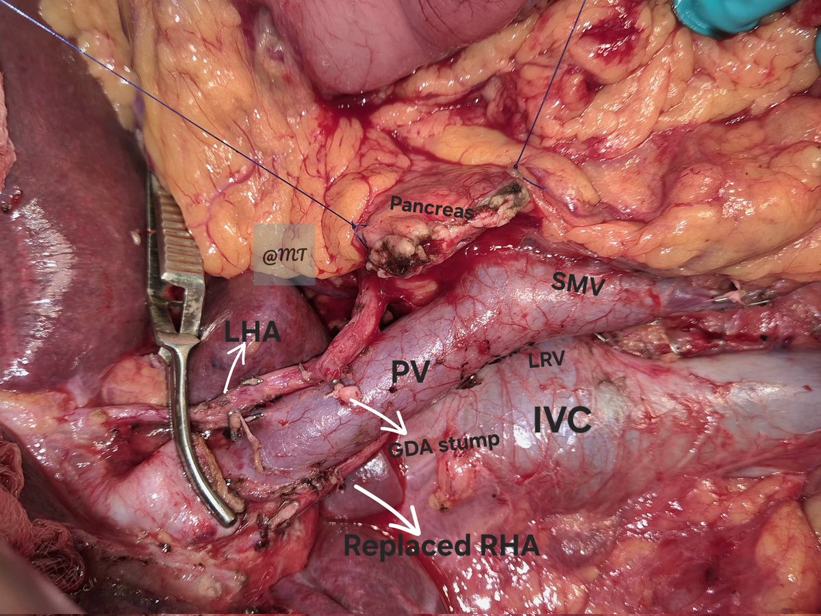Mayank_Oncology's tweet image. A week full of anatomical surprises. In our series of 350 pancreatoduodenectomies, a replaced right hepatic artery was encountered in nearly 20% of cases—an important reminder of the vascular variability that shapes HPB surgery @IHPBA @EAHPBA @AHPBA