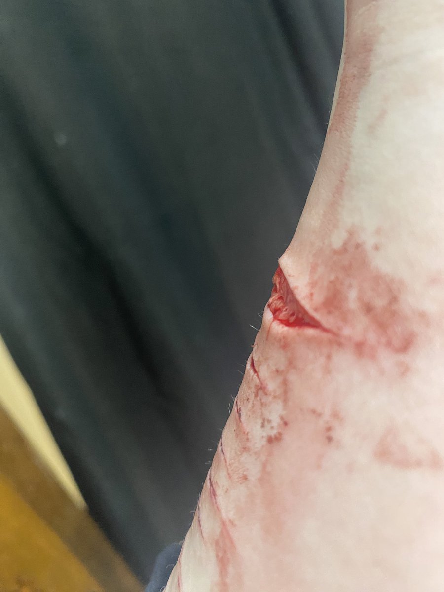 lexiiiess's tweet photo. @only_mimi2 hello, please someone help me identify what depth this is. i did it on accident and i am scared of how it may scar, or how long it will take to scar. https://t.co/tK5v8Dvf6k